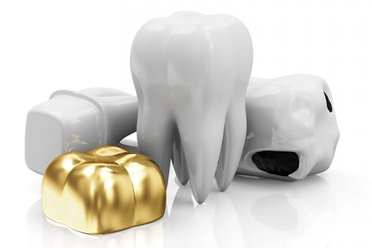 Common Dental Crown Materials and Their Benefits Global Beauty LLC