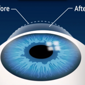 The Differences Between Lasik And Lasek Eye Surgery