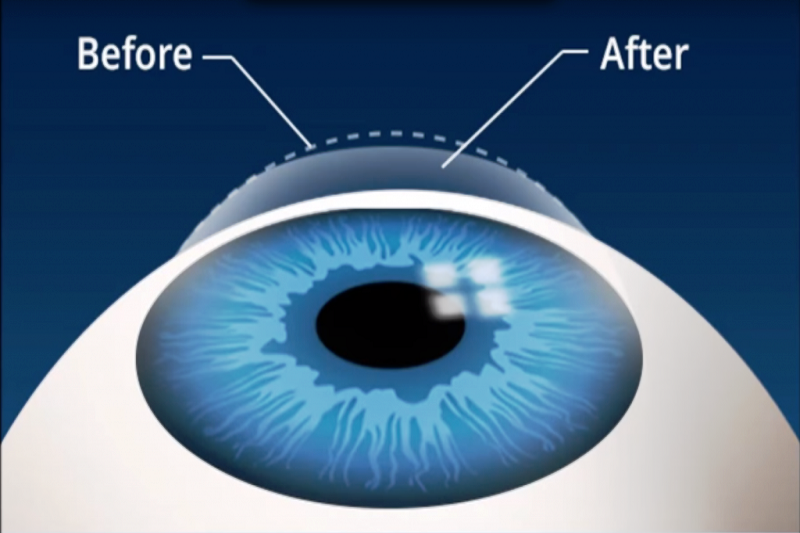 The Differences Between Lasik And Lasek Eye Surgery
